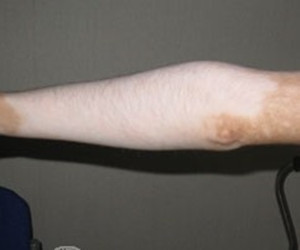 手臂白癜风患者应该怎么做