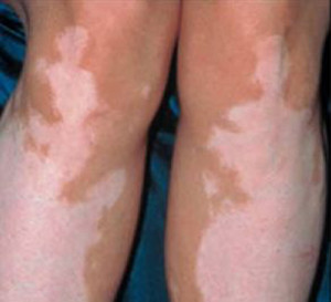女性肢端型白癜风的早期症状