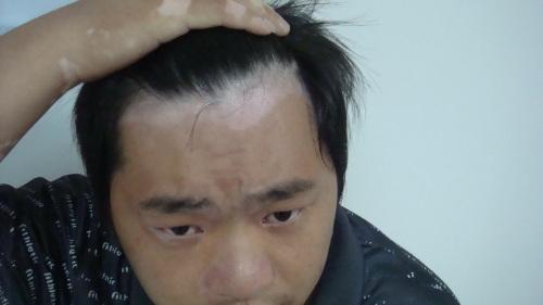 北京治疗白癜风医院：男性白癜风的危害表现是什么